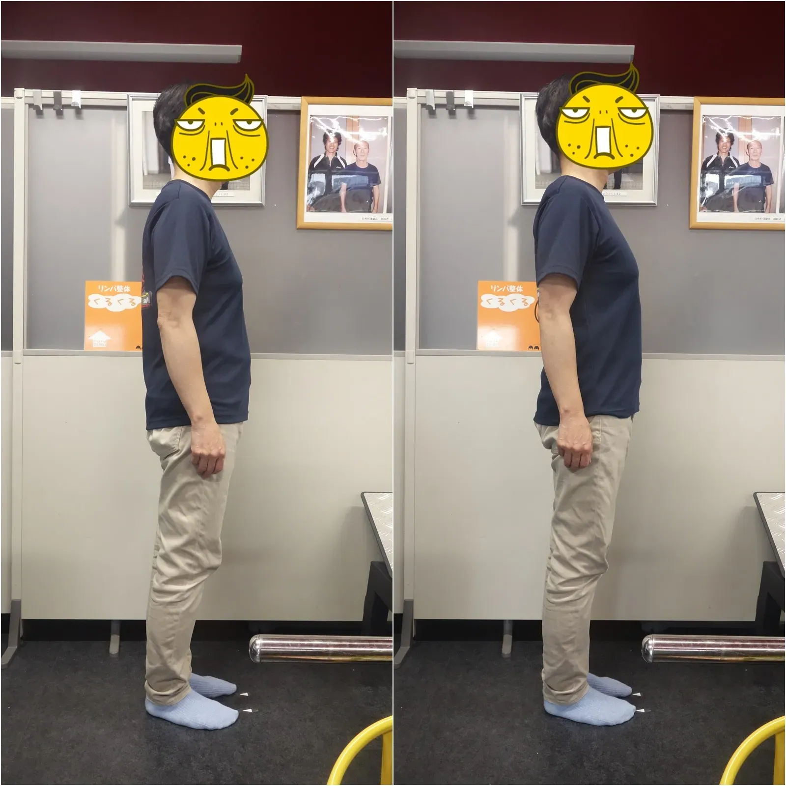 姿勢矯正治療例